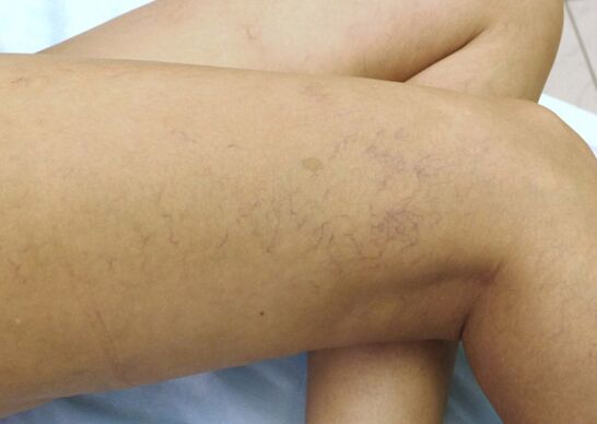 Αγγειακά αστέρια